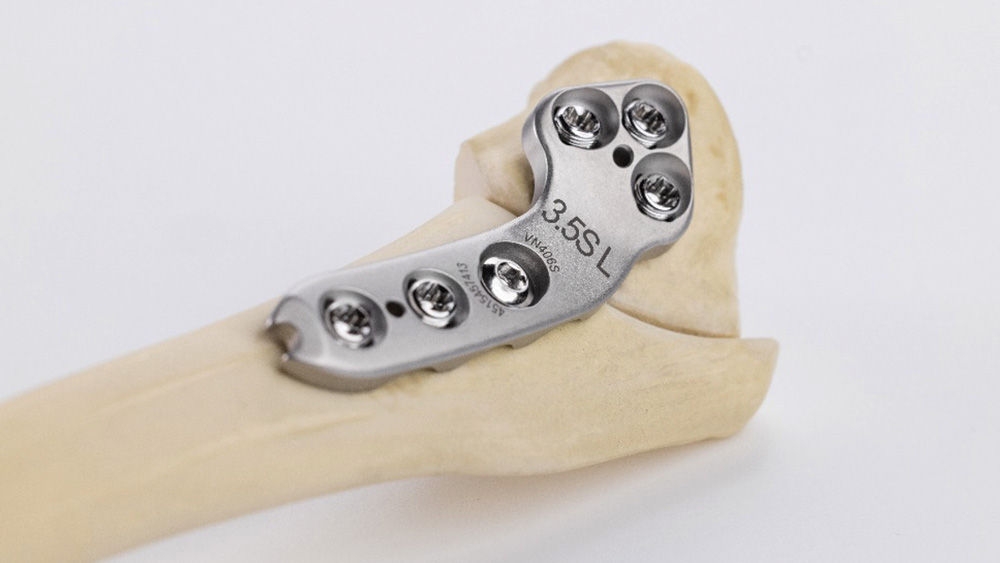 Angebrachtes PLS 2 TPLO-Implantat an einem Knochen zur Kreuzbandrissversorgung