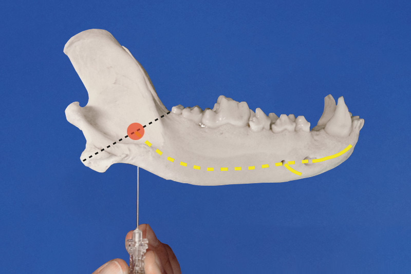 NervusAlveolarisInferiorBlock